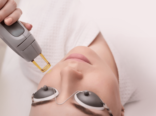 laser treatment for acne scars